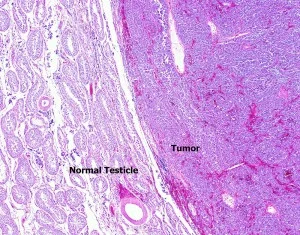 Gao-Gao-Tumor-4X-300x235