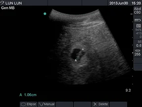 lunlun_ultrasound_cub2013_ZA_Image-1348